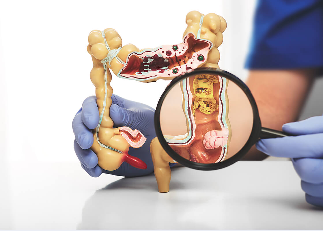 How Colorectal Cancer is Diagnosed